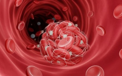 Boala ficatului gras non-alcoolic asociată cu un risc crescut de tromboembolism venos