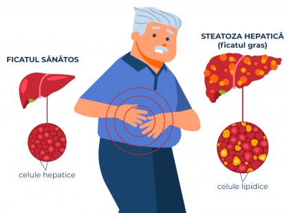 Lactobacillus acidophilus ar putea preveni cancerul hepatic asociat cu boala ficatului gras