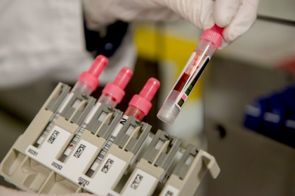 Indicele de dispoziție statică - instrument de predicție precoce simplă și fiabilă a diabetului