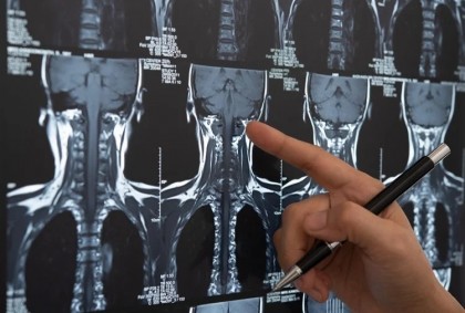 Alcoolul, fumatul și obiceiurile alimentare asociate cu un risc mai mare de a dezvolta cancer la cap sau la gât