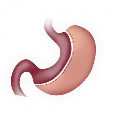 Intervenția chirurgicală din sfera bariatrică cea mai bună pentru a obține remisia diabetului