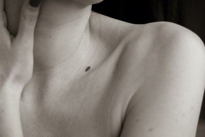 Melanomul se poate prezenta diferit pe tonurile mai închise ale pielii