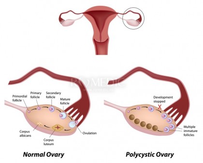 Cercetările leagă nivelurile scăzute de oxitocină de simptomele sindromului ovarului polichistic