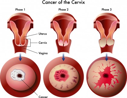 Biomarkeri din mucusul ecrvical ar putea ajuta la detectarea timpurie a cancerului cervical