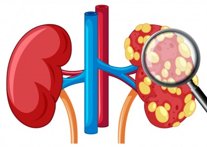 Progrese în cercetarea și tratamentul cancerului de rinichi