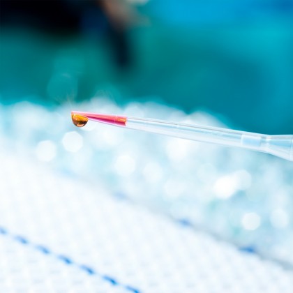 Risc cardiovascular global semnificativ legat de niveluri ridicate ale lipoproteinei (a)