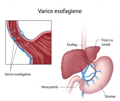 Terapia cu octreotidă de 24 de ore este la fel de eficientă ca cea de 72 de ore în tratarea hemoragiei variceale esofagiene