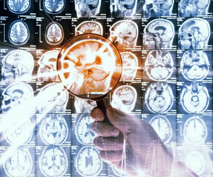 Tratamentul cu heparină a fost asociat cu un diagnostic întârziat al demenței Alzheimer