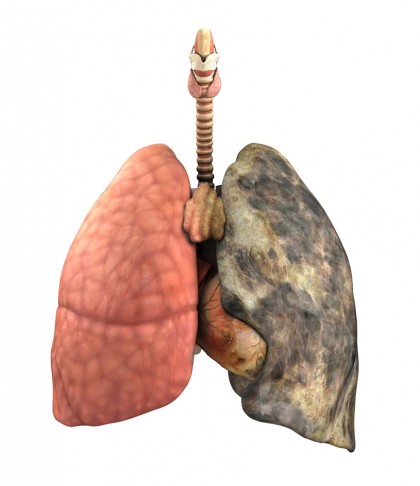 Conștientizarea scăzută a screening-ului cancerului pulmonar ridică îngrijorări