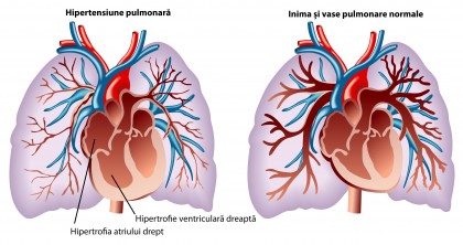 Activarea receptorului de vitamina D încetinește creșterea excesivă a celulelor în hipertensiunea pulmonară