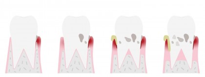 Parodontoza: cauze, simptome și tratament eficient pentru sănătatea gingivală