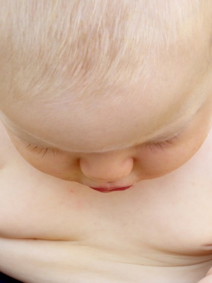 Dupilumab ameliorează simptomele dermatitei atopice la copiii cu afecțiuni coexistente