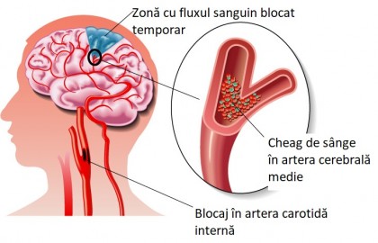 Disparități de gen în respectarea tratamentului post-accident vascular cerebral ischemic