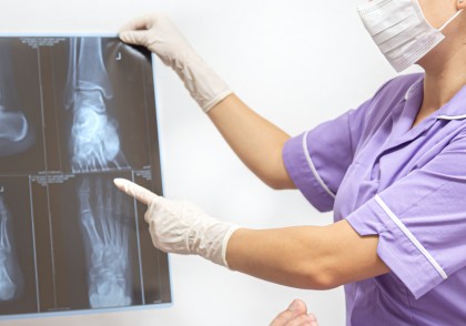 Studiu revoluționar schimbă modul în care osteosarcoamele sunt diagnosticate și tratate