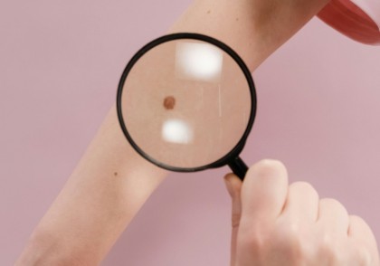 Imunoterapia topică elimină leziunile cutanate precanceroase și reduce riscul de cancer