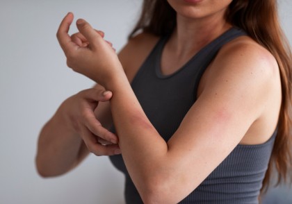 Cum influențează stresul inflamația alergică cutanată