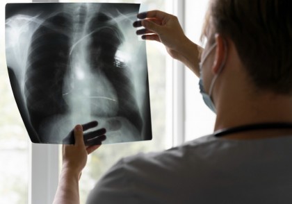Tratamentul cancerului pulmonar cu nanoparticule proteice mucoadezive