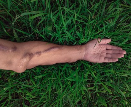 Cercetările identifică o nouă țintă moleculară pentru tratarea cheloizilor