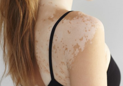 Compus microbian oferă speranță pentru tratamentul vitiligo