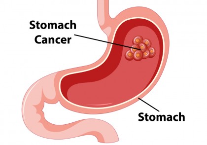 Descoperirea moleculelor ARN care ar putea favoriza cancerul gastric