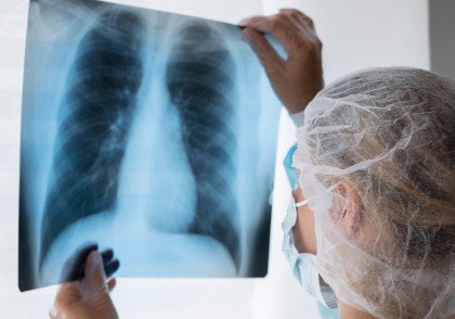 O nouă cale terapeutică promițătoare ar putea încetini progresia fibrozei pulmonare