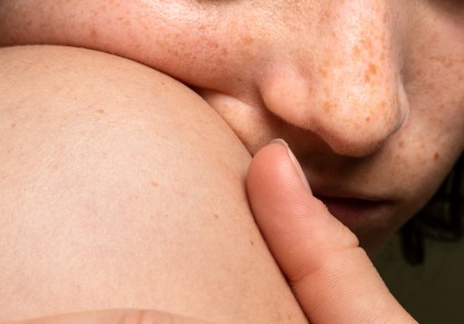 Microbiota cutanată: un partener esențial în modelarea imunității, inflamației și bolilor cronice ale pielii