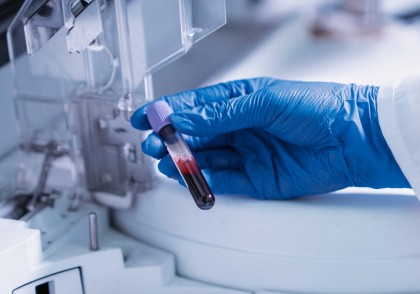 5 proteine sangvine pot prezice riscul de boală hepatică severă cu până la 16 ani înainte de debutul simptomelor