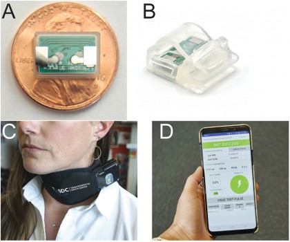 Pacienții cu tulburare de stres posttraumatic prezintă beneficii pe termen lung în urma stimulării nervului vag