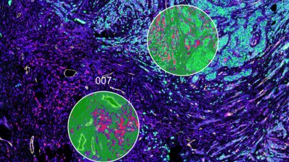Reprogramarea macrofagelor tumorale prin bexmarilimab: sensibilitatea este determinată de microambientul tumoral