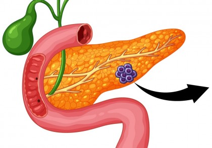 Microbiomul intestinal ar putea ajuta la detectarea precoce a cancerului pancreatic și la dezvoltarea de terapii noi