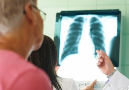 Livrarea genetică direct în plămâni: un nou sistem promițător pentru tratarea cancerului pulmonar și a fibrozei chistice