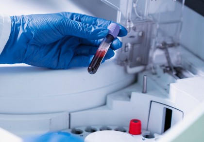 Detectarea cancerului cu trei ani înainte de diagnostic: o nouă eră a testelor sanguine de detecție timpurie