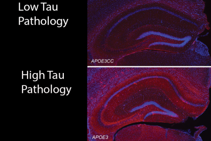 O variantă genetică rară protejează împotriva bolii Alzheimer prin inhibarea inflamației cerebrale