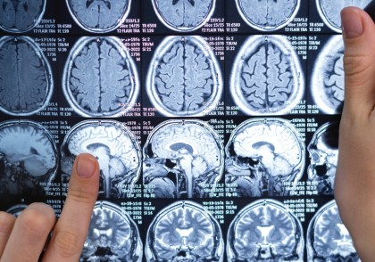 Nouă strategie terapeutică folosește microbiomul intestinal pentru a spori eficiența imunoterapiei în tratamentul glioblastomului