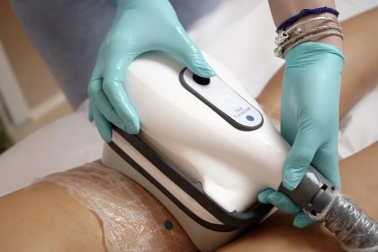 Criolipoliza: Tehnologia care îți modelează corpul fără bisturiu