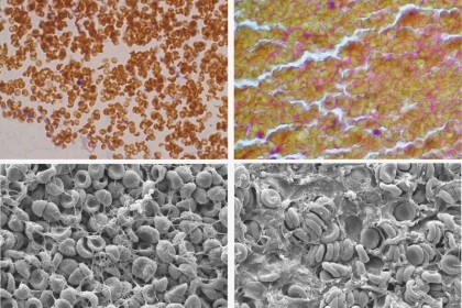 Un nou studiu dezvăluie rolul neașteptat al globulelor roșii în formarea cheagurilor