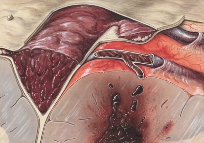 Trombectomie: Soluția rapidă în caz de AVC sau tromboză acută