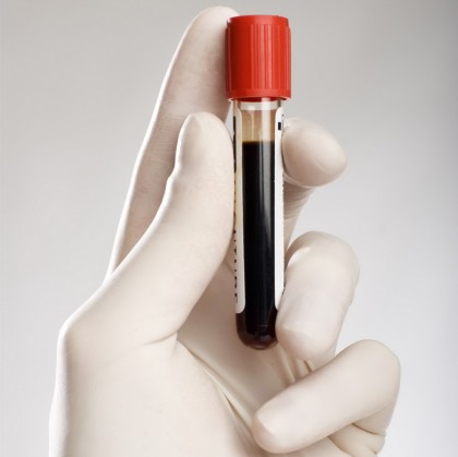 Biomarkeri epigenetici care prezic evenimente macrovasculare la persoanele cu diabet zaharat de tip 2