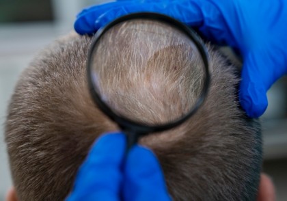 Nutriția și sănătatea părului: o analiză a 17 studii și peste 61.000 de participanți