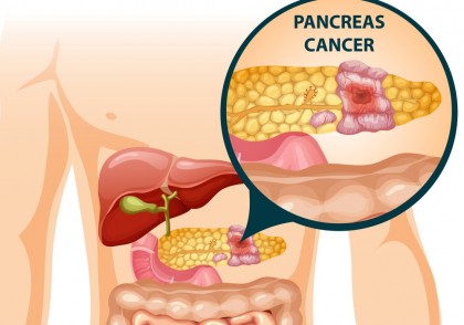 Progrese în terapia țintită a cancerului pancreatic ductal: noi speranțe împotriva mutației KRAS
