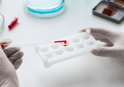 Un singur anticorp responsabil de trombocitopenia indusă de heparină