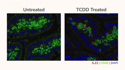 Fumatul alimentează dezvoltarea cancerului pancreatic prin imunosupresie
