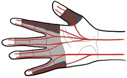 Sutura nervilor digitali nu îmbunătățește semnificativ recuperarea senzorială, conform noilor date clinice