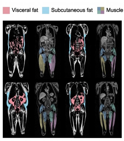 Grăsimea din jurul organelor îți poate afecta inima, chiar dacă faci exerciții fizice