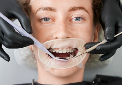 Abaloparatida stimulează formarea osului alveolar și ar putea preveni dehiscența parodontală