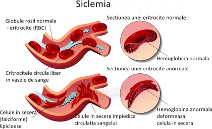 Durerea cronică în anemia falciformă: un nou mecanism mediat de microbiomul intestinal și bilirubină