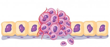 Flexibilitatea mortală a cancerului, sau cum mediul presiunea din țesuturi alimentează invazia și rezistența la medicamente