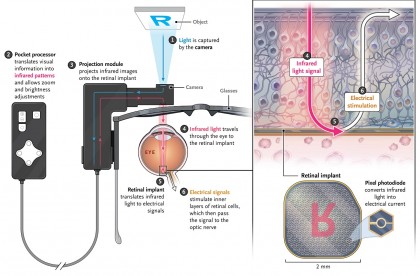 Revoluție în oftalmologie: implantul ocular electronic permite persoanelor oarbe să citească din nou