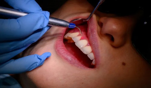 Stomatita aftoasă recurentă – cauze, simptome și tratament