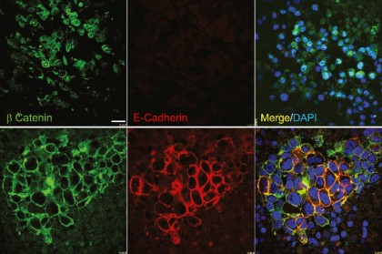 O strategie bazată pe inteligență artificială dezvăluie terapii capabile să reconfigureze și să elimine celulele stem canceroase